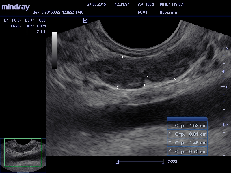 узи простаты, семенные пузырьки