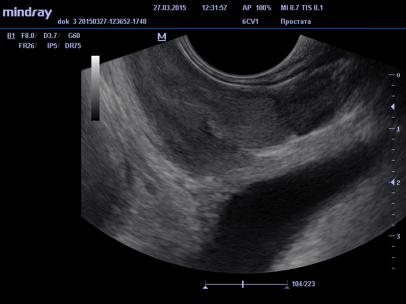 сагиттальный срез предстательной железы