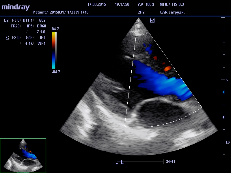 УЗ диагностика сердца