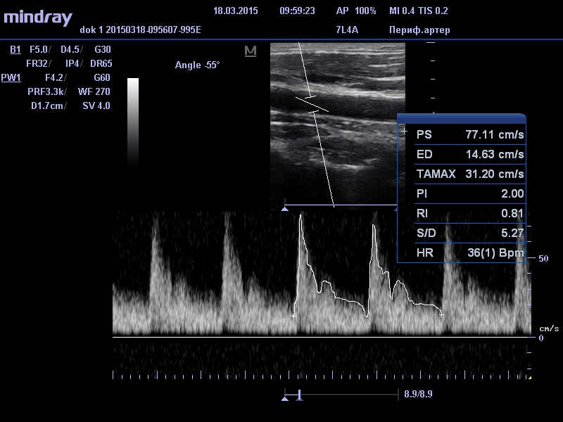 сонные артерии