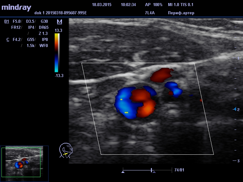 УЗИ сонных артерий