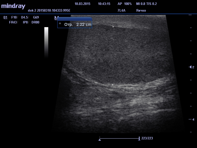 УЗИ мошонки - яичко