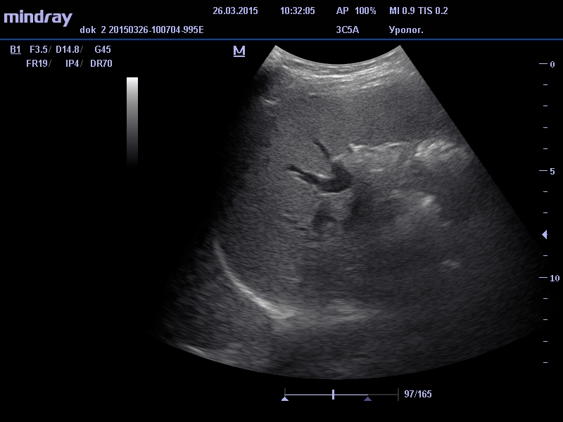 селезенка на УЗИ