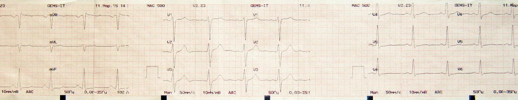 Кардиограмма сердца Кардиограмма сердца