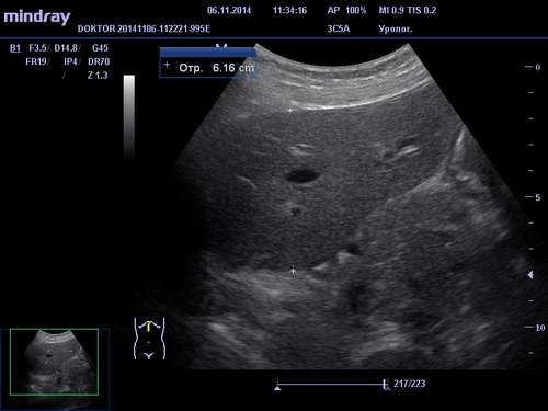 УЗИ поджелудочной железы