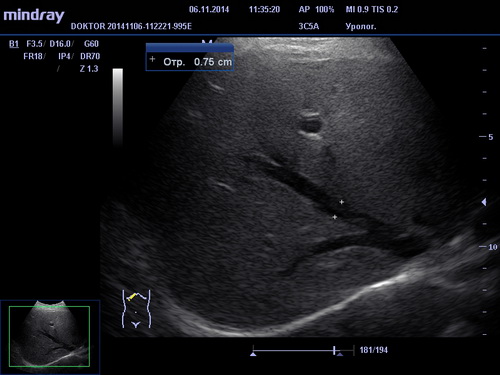 УЗИ брюшной полости