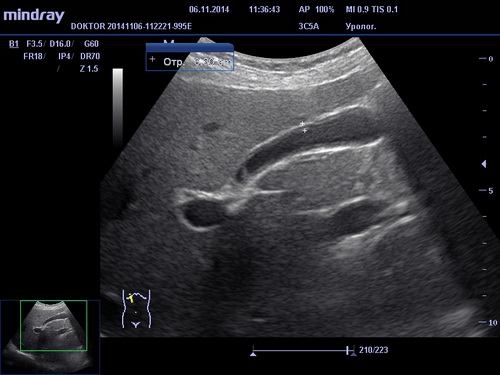 УЗИ органов брюшной полости
