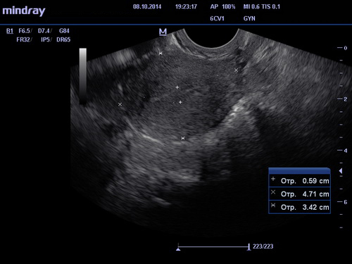 УЗИ органов малого таза