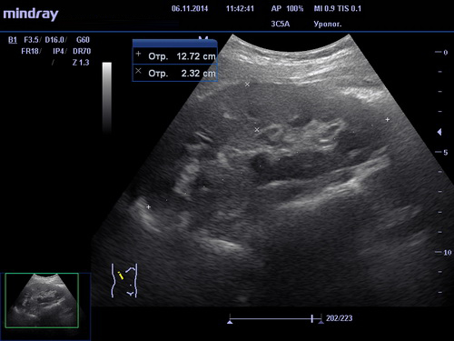 УЗИ почек вид сбоку