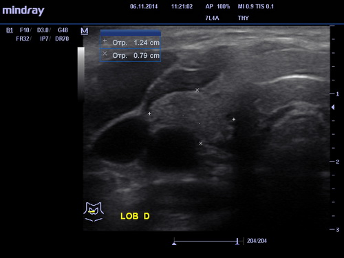 УЗИ щитовидной железы 1