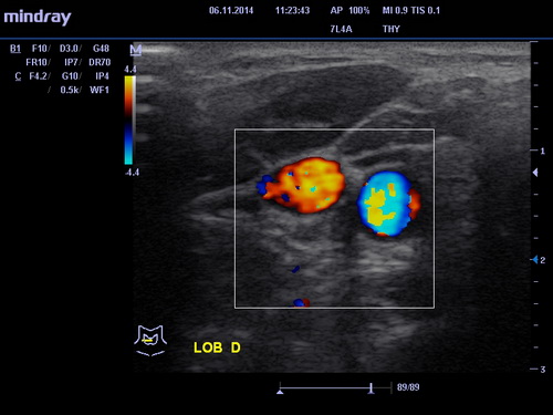 УЗИ щитовидной железы 2