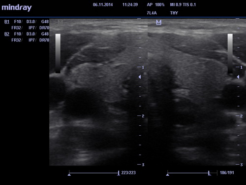 УЗИ щитовидной железы 3