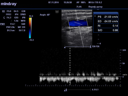 УЗИ сосудов