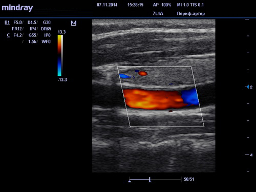 ультразвуковая допплерография