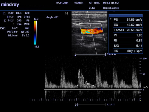 УЗИ сосудов - периф. артер